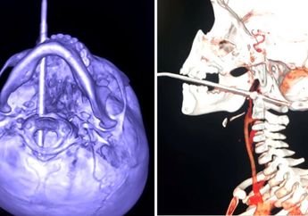 Dramatis, Seorang Bayi Selamat Setelah Telan Jarum Sepanjang 10 Cm