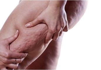 Inilah Cara Ampuh Hilangkan Selulit ala Model Victoria Secret, Langsung Mulus! Penasaran?