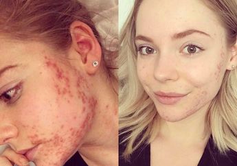 Wanita Ini Sukses 'Bersihkan' Wajahnya Yang Jerawatan Tanpa Obat Apapun, Cukup Dengan Hindari Makan Sesuatu