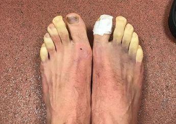 Bertanding Saat Musim Salju, Jari Kaki Pesepak Bola Berwarna Kuning Karena Kedinginan