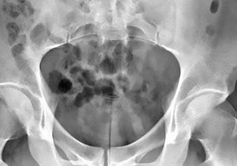 Ada Benda Asing Terjebak di Kandung Kemihnya, Seorang Pria Malah Tolak Temui Dokter Selama Dua Hari