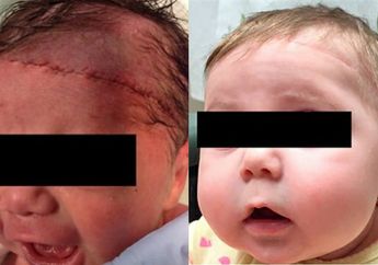 Teledor Saat Lakukan Operasi Caesar, Dokter Malah Menyayat Kulit Kepala Bayi