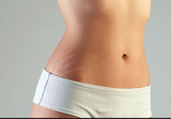 Cara Mencegah Timbulnya Stretch Marks di Tubuh Terutama Bagi Wanita yang Belum Melahirkan 
