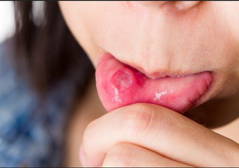 Sariawan Nggak Kunjung Sembuh? Ini Cara Menyembuhkan Sariawan Membandel Menurut Dokter Ahli