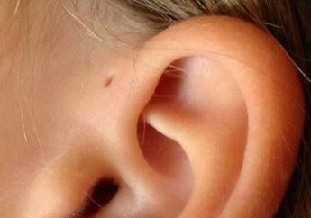 Kamu Punya Lubang Kecil di Atas Daun Telinga? Berikut Penjelasannya