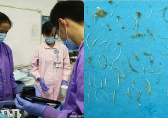 Dokter Temukan 100 Tulang di Tubuh Seorang Pria yang Makan Sup Ikan Mas