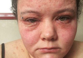 Gara-gara Pakai Pewarna Rambut Murahan, Wajah Wanita Ini Alami Iritasi Mengerikan