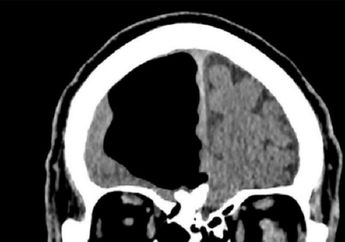 Merasa Badannya Kurang Sehat, Seorang Kakek Malah Menemukan Sebagian Otak Kanannya 'Hilang'!