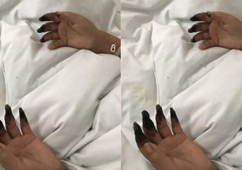 Dikira Hanya Infeksi Biasa, Jari-jari Seorang Wanita Malah Membusuk Tak Bisa Disembuhkan