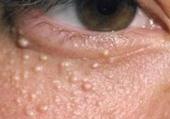 Punya Bintik Putih di Wajah? Jangan Khawatir, Begini Cara Menghilangkannya Secara Alami