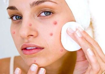 Nggak Perlu Keluar Uang Jutaan Rupiah Untuk Samarkan Noda Hitam dan Bekas Jerawat, Nggak Percaya?