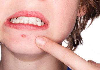 Wah 4 Bahan Alami Ini Mampu Mengatasi Masalah Jerawat Pada Wajah Kamu, Sudah Tahu?