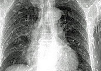 Mengerikan, Hampir Seluruh Tubuh Pria Ini Dipenuhi Oleh Cacing Pita, Begini Penyebabnya