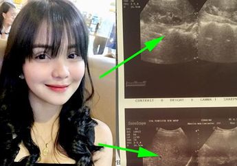 Tidak Pernah Sarapan, Wanita Ini Alami Kondisi Menyakitkan Sampai Tak Bisa Makan Banyak!