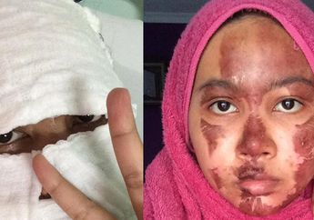Wajahnya Terbakar, Wanita Ini Bagikan Pengalaman Buruk Pakai Panci Presto