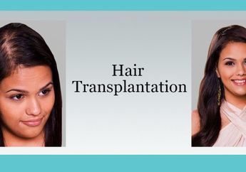 Solusi Kebotakan dengan Transplantasi Rambut, Bahaya Nggak ya?