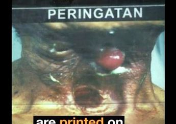 Kisah Edison, Pemilik Leher Berlubang dan Mengerikan di Bungkus Rokok, Kini Masih Hidup dan Menderita