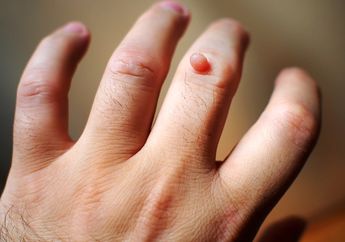 Luar Biasa, Cuma Pakai Dua Bahan Alami Kutil Bisa Hilang dalam Waktu Singkat loh