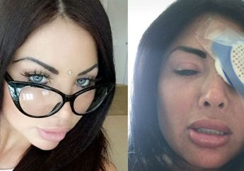 Lakukan Operasi Perubahan Warna Mata, Wanita Ini Kehilangan Penglihatannya