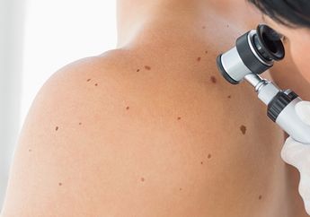 Waspada! 6 Hal Sederhana yang Menjadi Penyebab Kanker Kulit