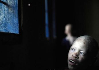 Sadis, Sudah 80 Albino Dibunuh dan Organnya Dijual, Katanya Bisa Datangkan Keberuntungan