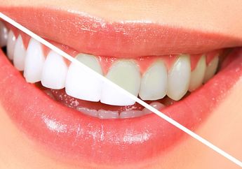 Plus Minus Metode Memutihkan &lsquo;Bleaching&rsquo; Gigi yang Perlu Kamu Tahu
