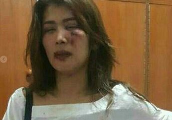 Wajah Cut Zara Babak Belur Akibat KDRT, Netizen Geram!