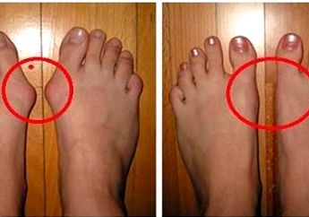 Keseringan Pakai High Heels, Bisa Kena Bunion dan Dioperasi, Begini Kata Dokter Bedah Eko Wahyu
