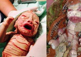 Kisah Bayi Dania, Lahir Kondisinya Seperti ini, Kini Beginilah Dia Sudah Tumbuh Besar