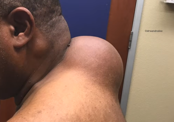 Ada Bola Bowling di Punggung Pria Ini, Begini Cara Dokter Mengeluarkannya