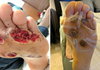 Ngeri, Kaki Infeksi Bakteri Pemakan Daging Akibat Mandi 'Nyeker' di Tempat Gym