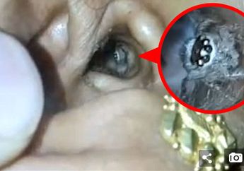 Dokter THT Bengong, Sinari Telinga Pasien, Ada Hewan ini Merangkak Keluar! Lihat Videonya