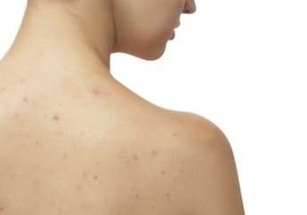 Jerawat Membandel di Punggung? Atasi Dengan Bahan Alami di Bawah Ini