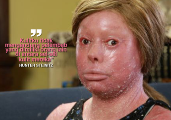 Gadis Ini Tidak Pernah Bisa Menutup Matanya dan Kulitnya Tebal, Ternyata Ini Yang Terjadi