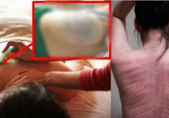Mengerikan, Wanita Ini Nyaris Lumpuh Usai Dikerok dengan Cara Seperti Ini