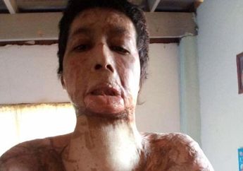 Istri yang Dibakar Suami Karena Selfie, Tetap Memaafkan Demi Cinta