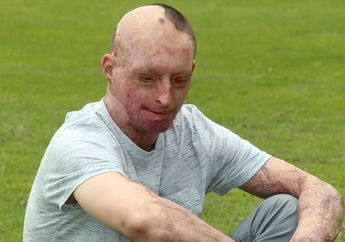 Sadis, Wajah Pria Ini Meleleh Akibat Disiram Cairan Asam Oleh Pacarnya Sendiri yang Cemburu