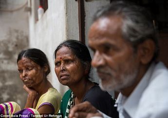Miris, Akibat Terlalu Miskin, Wanita Ini Rela Tinggal Kembali Bersama Pelaku Penyiram Zat Asam ke Wajahnya