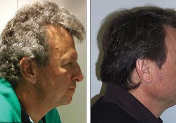 Ajaib, Penderita Kanker Mendapati Rambut Beruban Mereka Jadi Lebih Gelap