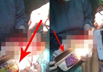 Gempar! Dokter di Jember Bedah Perut Pasien, Astagfirullah...Videonya Ada Benda Beginian 16 Biji