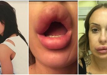 Salah Suntik, Niatnya Mau Tampil Cantik, eh Bibir Wanita Ini Terancam Rusak dan Hilang!