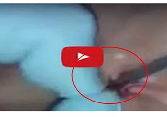 Serem, Seperti Ini Loh Ketika Susuk Dikeluarkan Dari Tubuh Manusia, Mengerikan