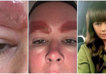 Habis Perawatan Tato Alis, Wanita Cantik Ini Kesakitan dan Kulit Wajahnya Mengelupas Bengkak dan Bernanah