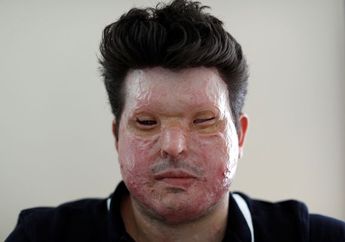 Sial Bener, Wajah Pria Ini Hancur Disiram Cairan Asam, Salah Sasaran Pula