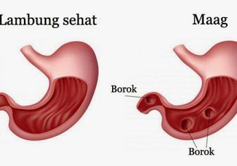 Melihat Berpulangnya dr Ryan Thamrin, Jangan Anggap Remeh Maag, Ini Teorinya!
