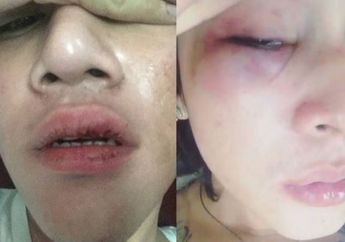 Dicky Smash Ungkap 2 Ciri Pria yang Memukulinya di Kelab Malam, Serem! 