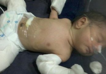OMG! Bayi Laki-Laki Baru Lahir 'Hamil', Ada Penyusup Saat Masih Dalam Kandungan