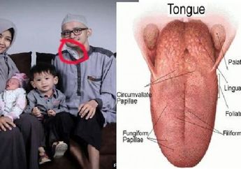 Berkaca Kisah Andrie K Farid, Ini 4 Penyebab Kanker Lidah yang Setahun Bisa Renggut Nyawa!