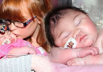 Dokter Angkat Tangan, Bayi ini Lahir dengan Otak di luar Tengkorak! Si kecil ini Tetap Berjuang untuk Hidup!