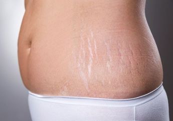 Nggak Cuman Berat Badan Naik yang bisa Nimbulin Stretch Mark, Tapi Berat Badan Turun Juga bisa! Nih cara Mencegahnya
